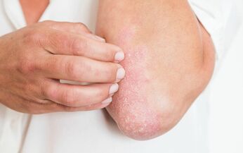 Psoriasis is associated with constant itching