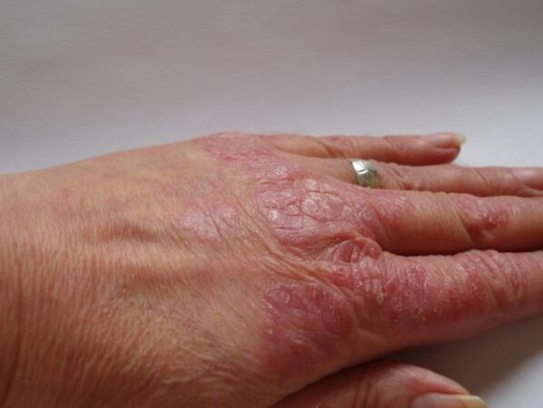 psoriasis plaques on the hands