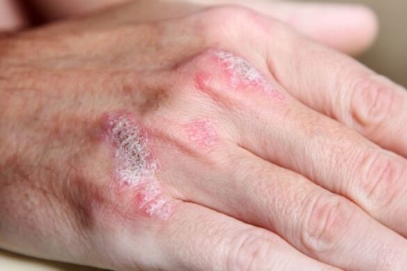 symptoms of psoriasis on the hands