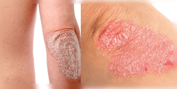 how does psoriasis look on the skin