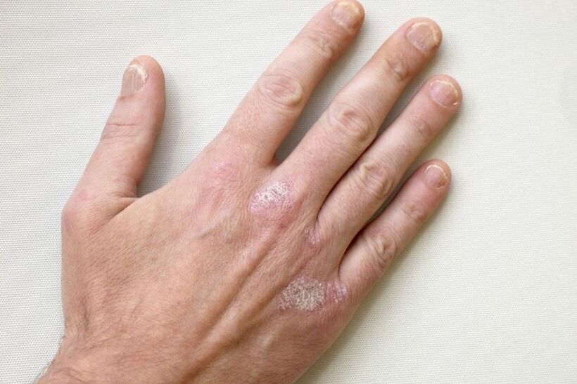 The mandatory symptom of psoriasis is scaly plaques on the skin