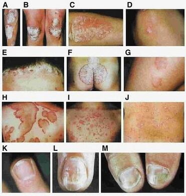 The signs of psoriasis depend on the type of the disease