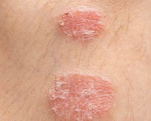 The appearance of psoriasis plaques