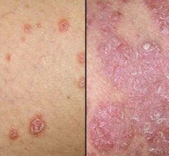 Psoriasis plaques