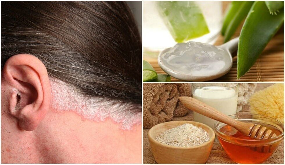Treatment of psoriasis with folk medicine