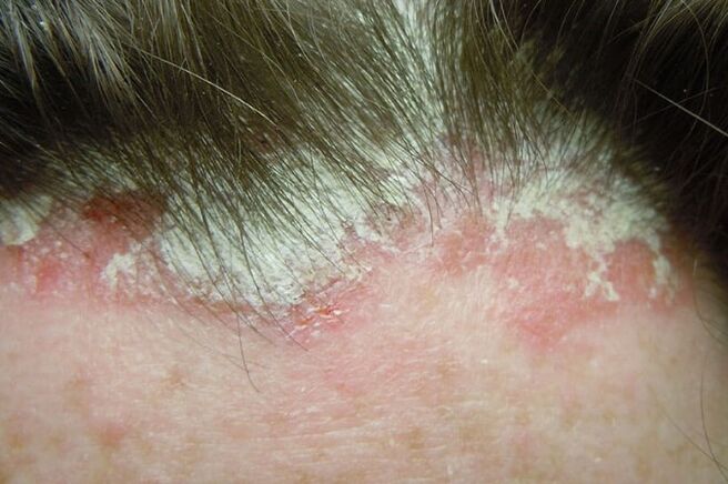 Psoriasis seizes the full hairy part of the head