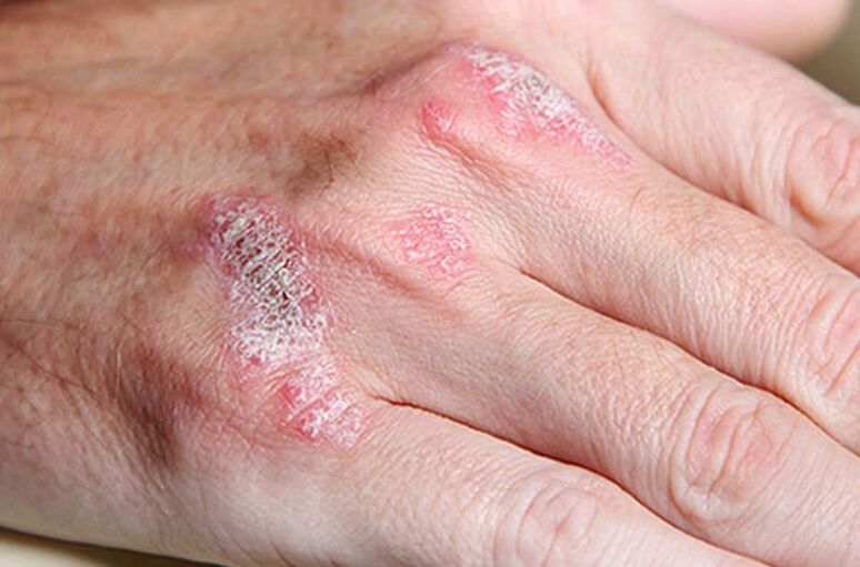 Psoriasis