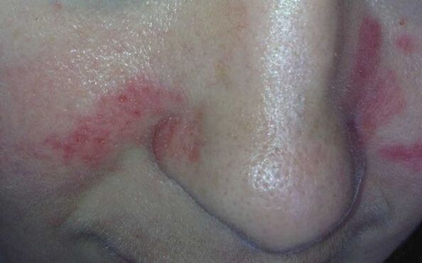 Symptoms of psoriasis on the face