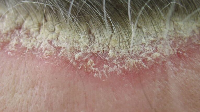 The scalp psoriasis