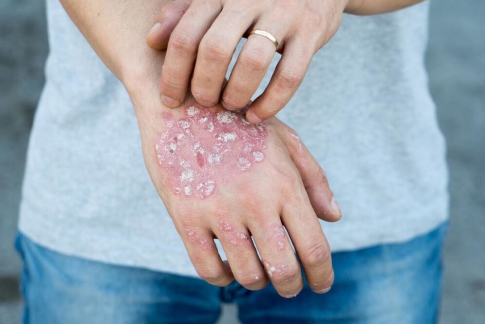 The psoriasis is