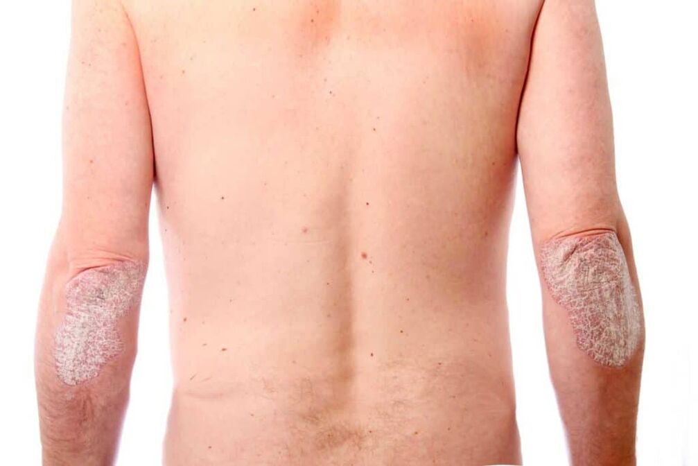 The second stage of psoriasis