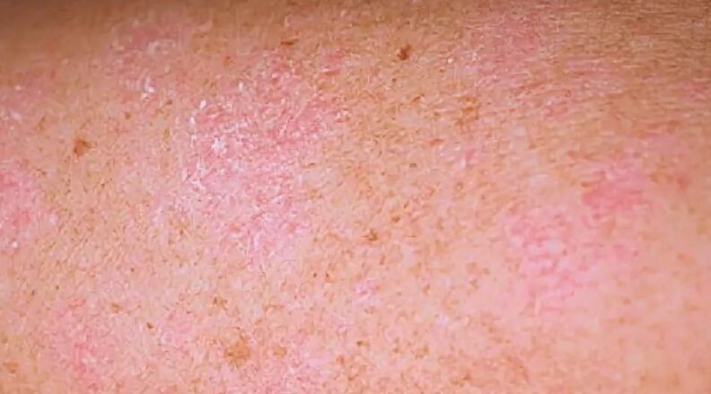 The regressive section of psoriasis
