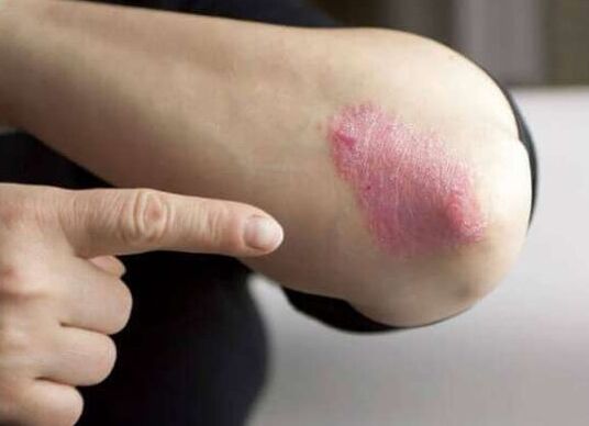 The stationary stage of psoriasis