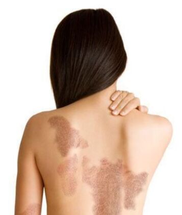 Stages of psoriasis depending on the area of ​​the lesion