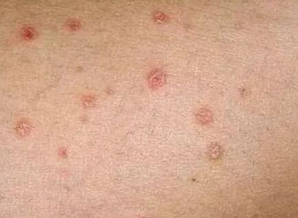 The initial stage is psoriasis