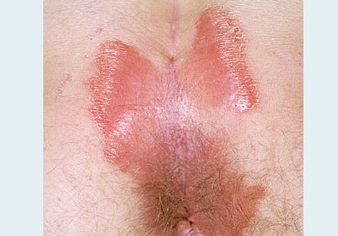 Closing psoriasis closure