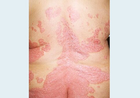 In the back of psoriasis