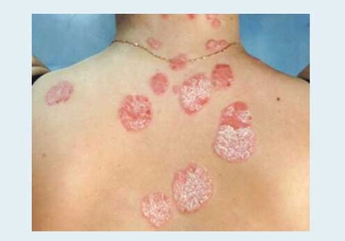 Psoriasis