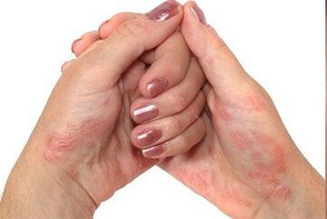 Psoriasis in the hands