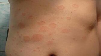 Psoriasis in the stomach