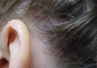 Psoriasis on his head