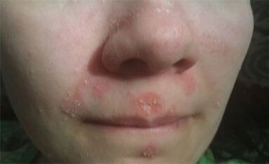 Psoriasis on the face