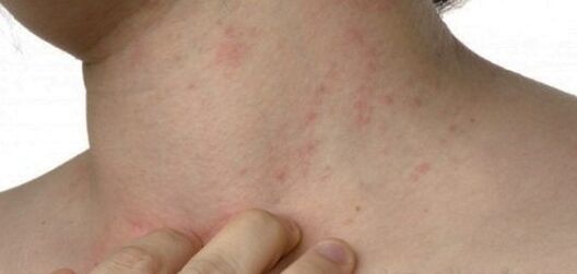 Psoriasis on the neck