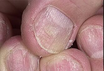 The nails are psoriasis
