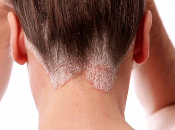 Psoriasis on his head