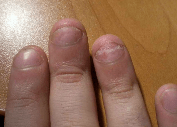 The nails are psoriasis