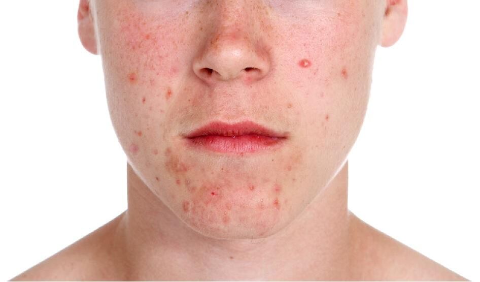 Psoriasis on the face