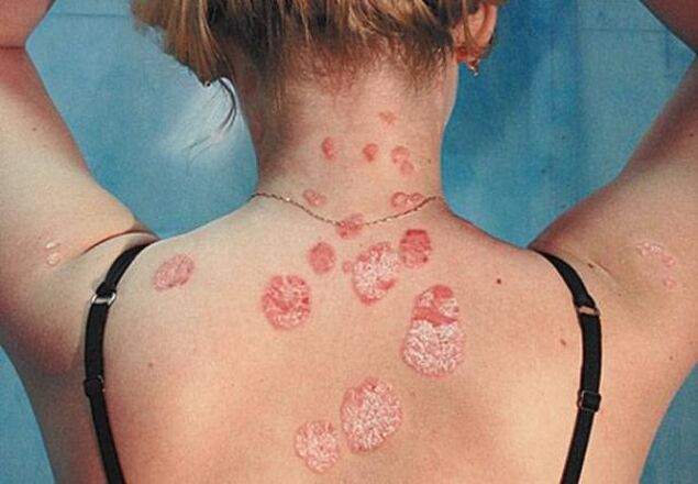 Psoriasis on his back