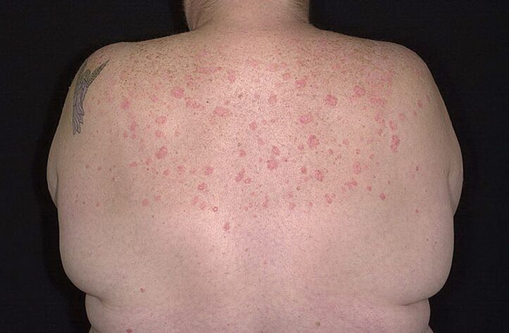 Psoriasis on the shoulders