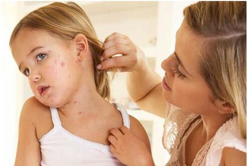 Photo of the initial stages of psoriasis