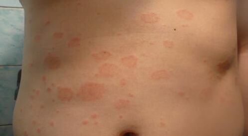 The initial stage is psoriasis