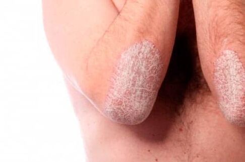Psoriasis on the elbow