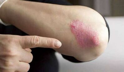 the stationary phase of the development of psoriasis