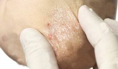 treatment of psoriasis in the weakening phase