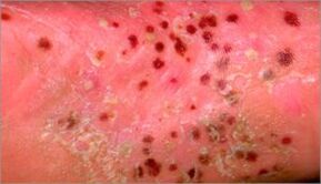 Pustular psoriasis