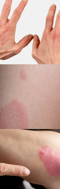 The initial stage of psoriasis on the hand