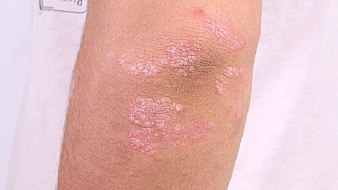 photo of early-stage psoriasis