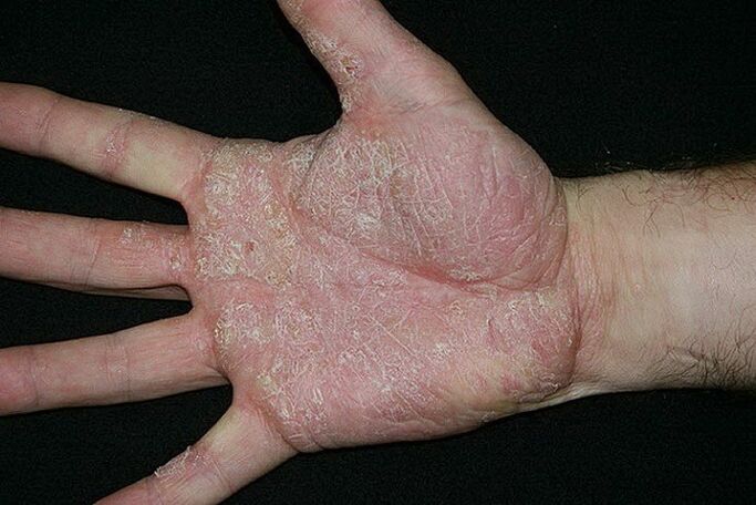 psoriasis on the palms and soles