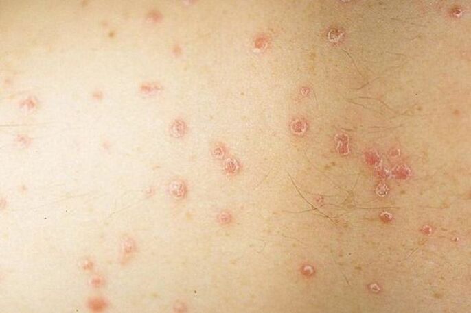 symptoms of patchy psoriasis