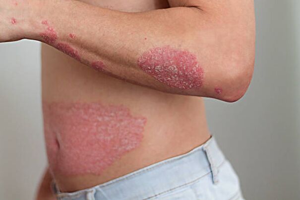 psoriasis in the human body