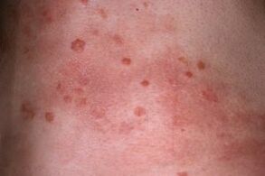 photo psoriasis on the skin
