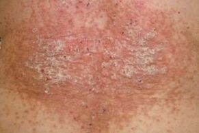 the siatial phase of psoriasis